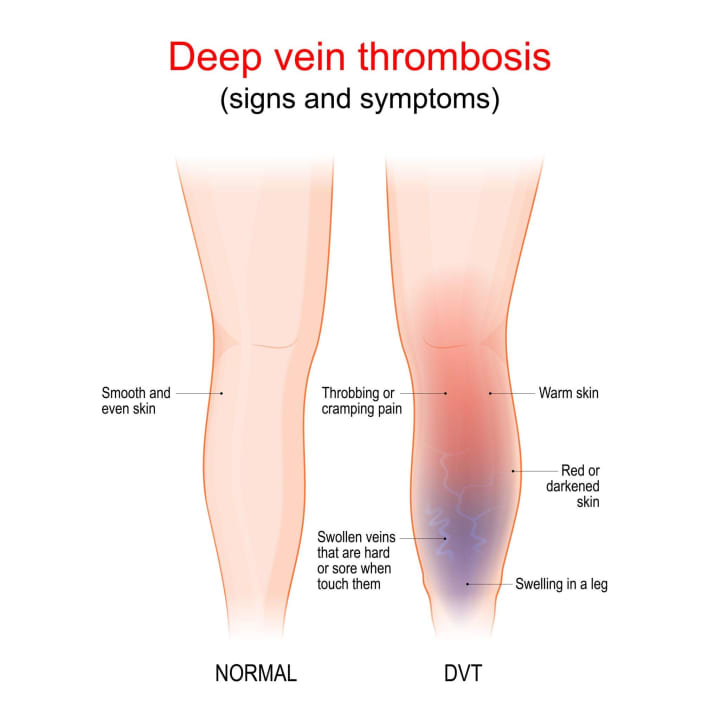 Postpartum / After delivery/ Varicose veins/blood clotting medical