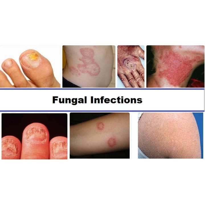 preventing-fungal-infections-education