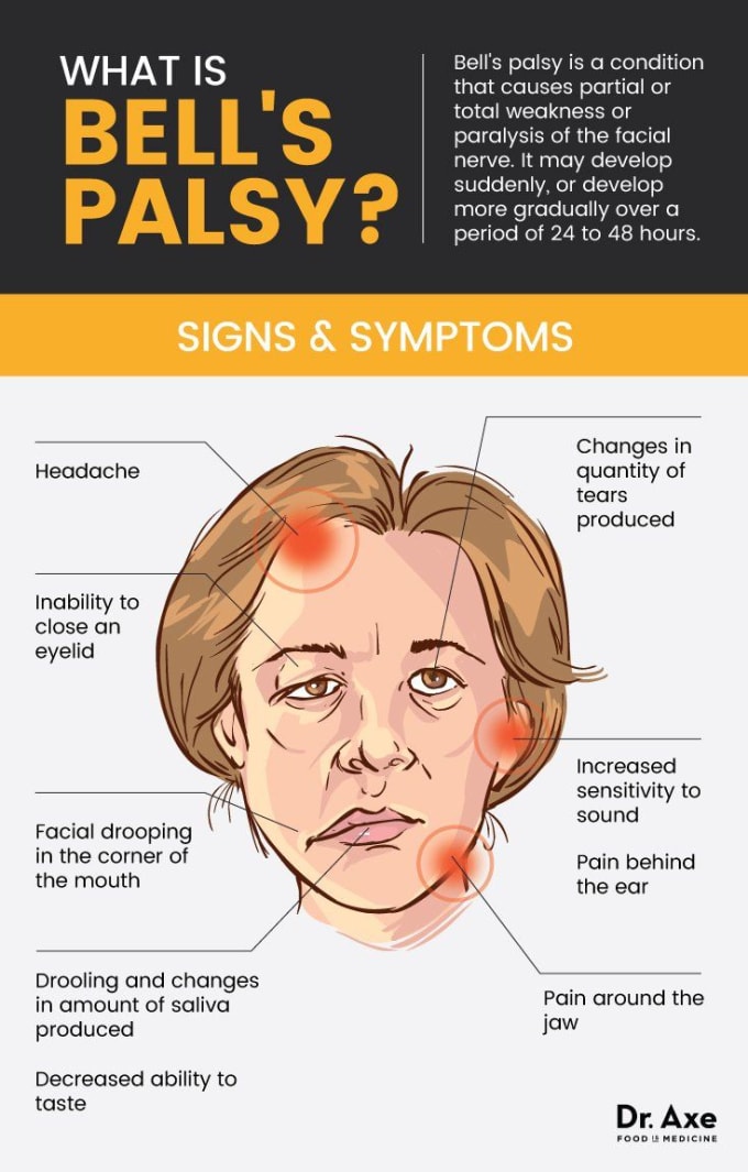  Bell s Palsy Longevity