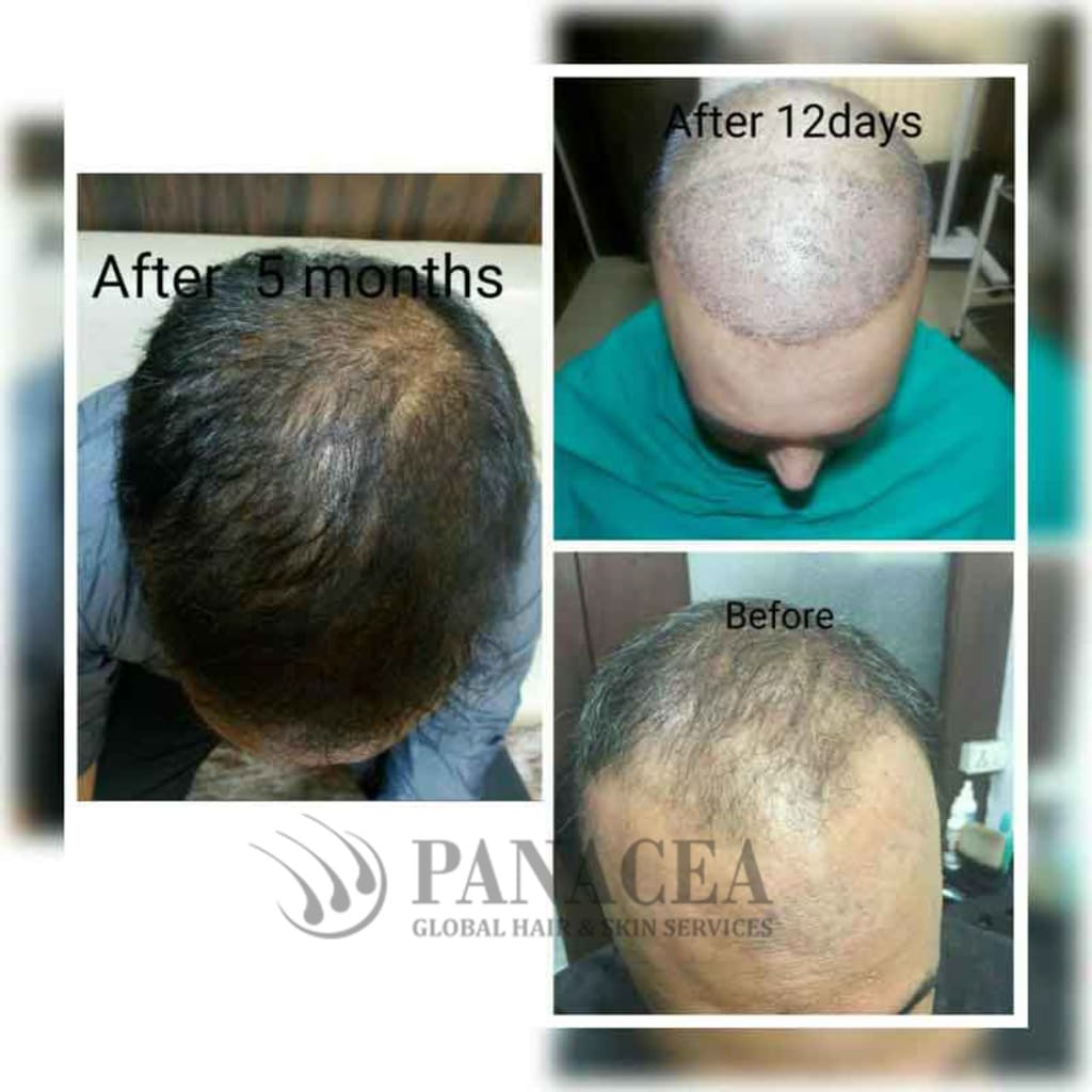 Facts And Myths About Hair Transplant Treatment Blush