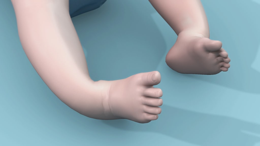 What are the causes & symptoms of clubfoot? Longevity