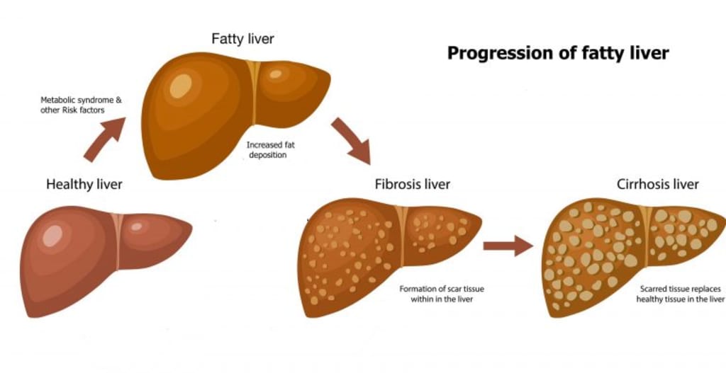 Understand All The Complications And Causes Of Fatty Liver Longevity