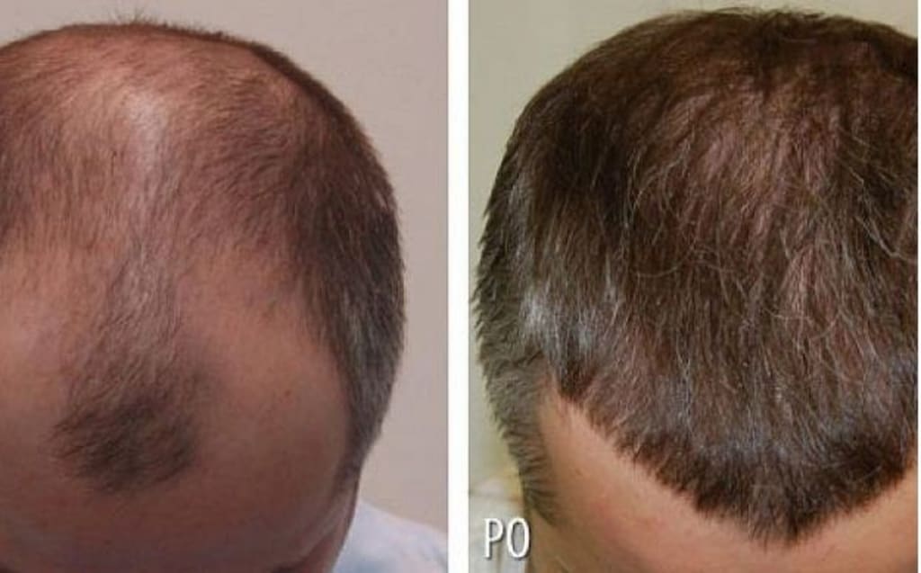 Hair Transplant Clinics in Turkey - Hair Transplant Mentor