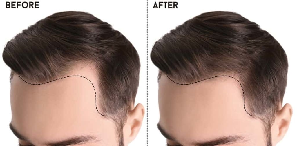 Best Hair Transplant and Loss Hair Treatment | Lifehack Best Hair Transplant and Loss Hair Treatment | Lifehack