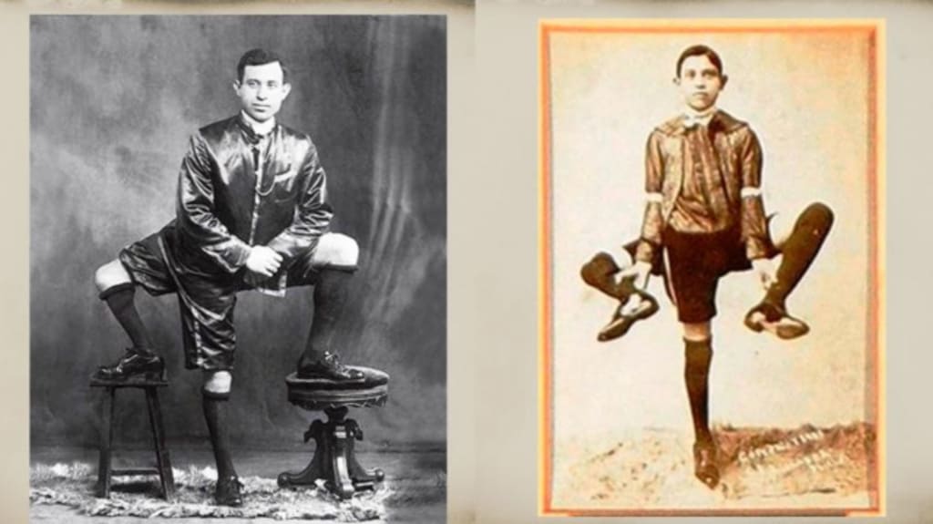 The 'ThreeLegged Man' Frank Lentini Facts and Stories Education