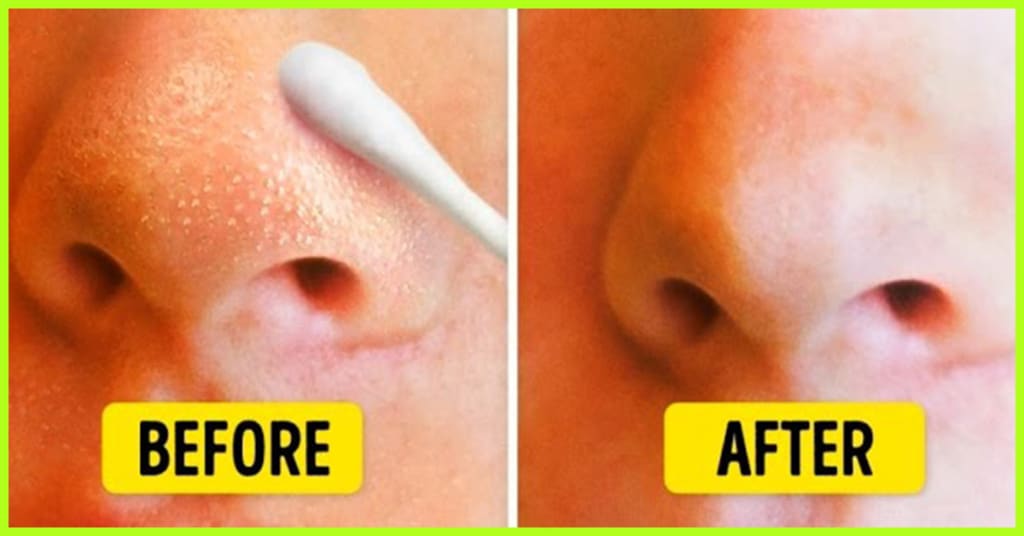 How to Get Rid of Blackheads | Blush How to Get Rid of Blackheads | Blush