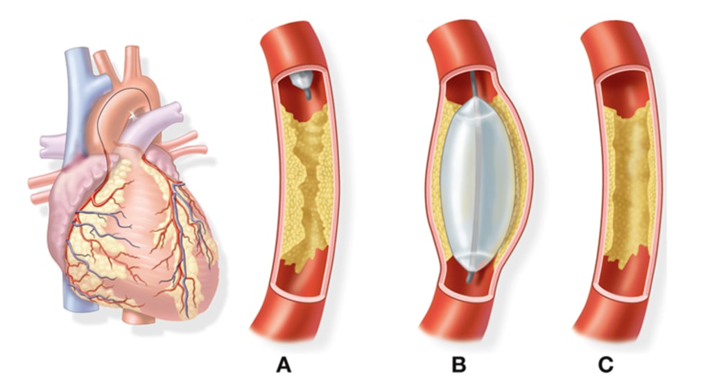 what is angioplasty surgery