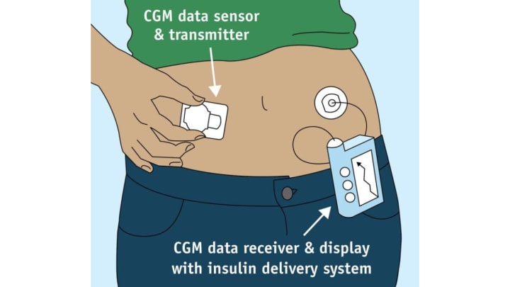 Real-Time CGM