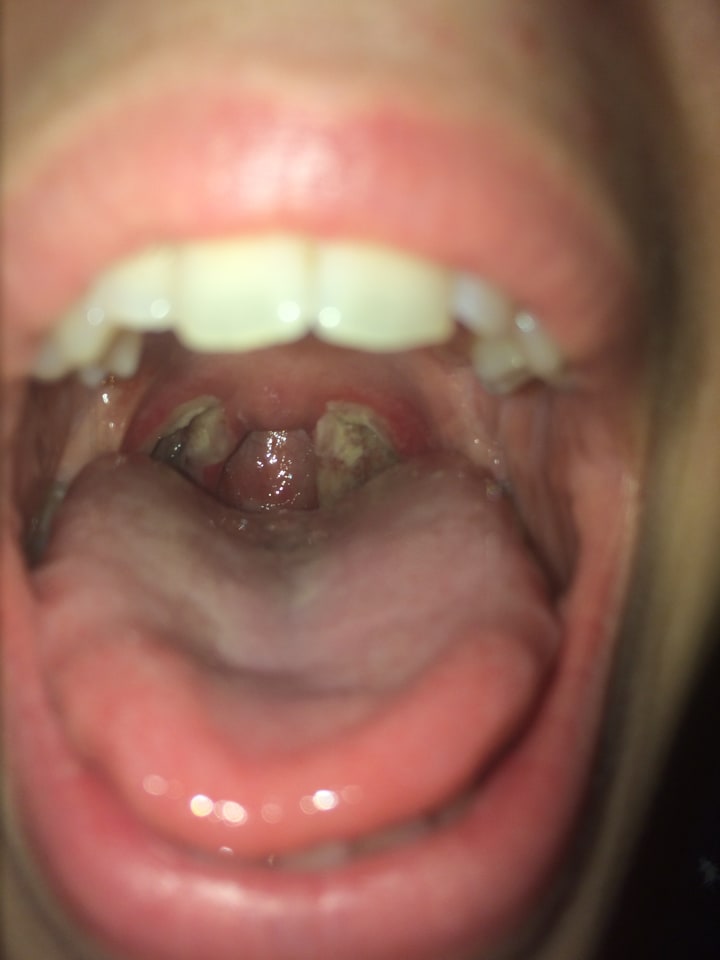 I Had My Tonsils Taken Out Longevity