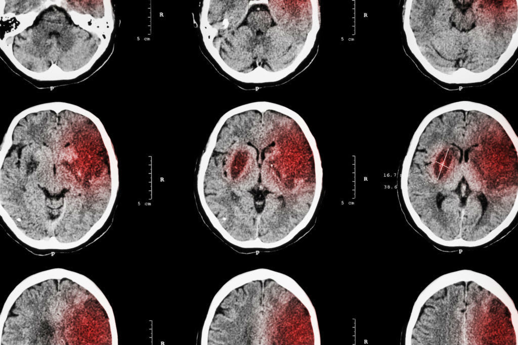 Being a Victim to a TBI Being a Victim to a TBI