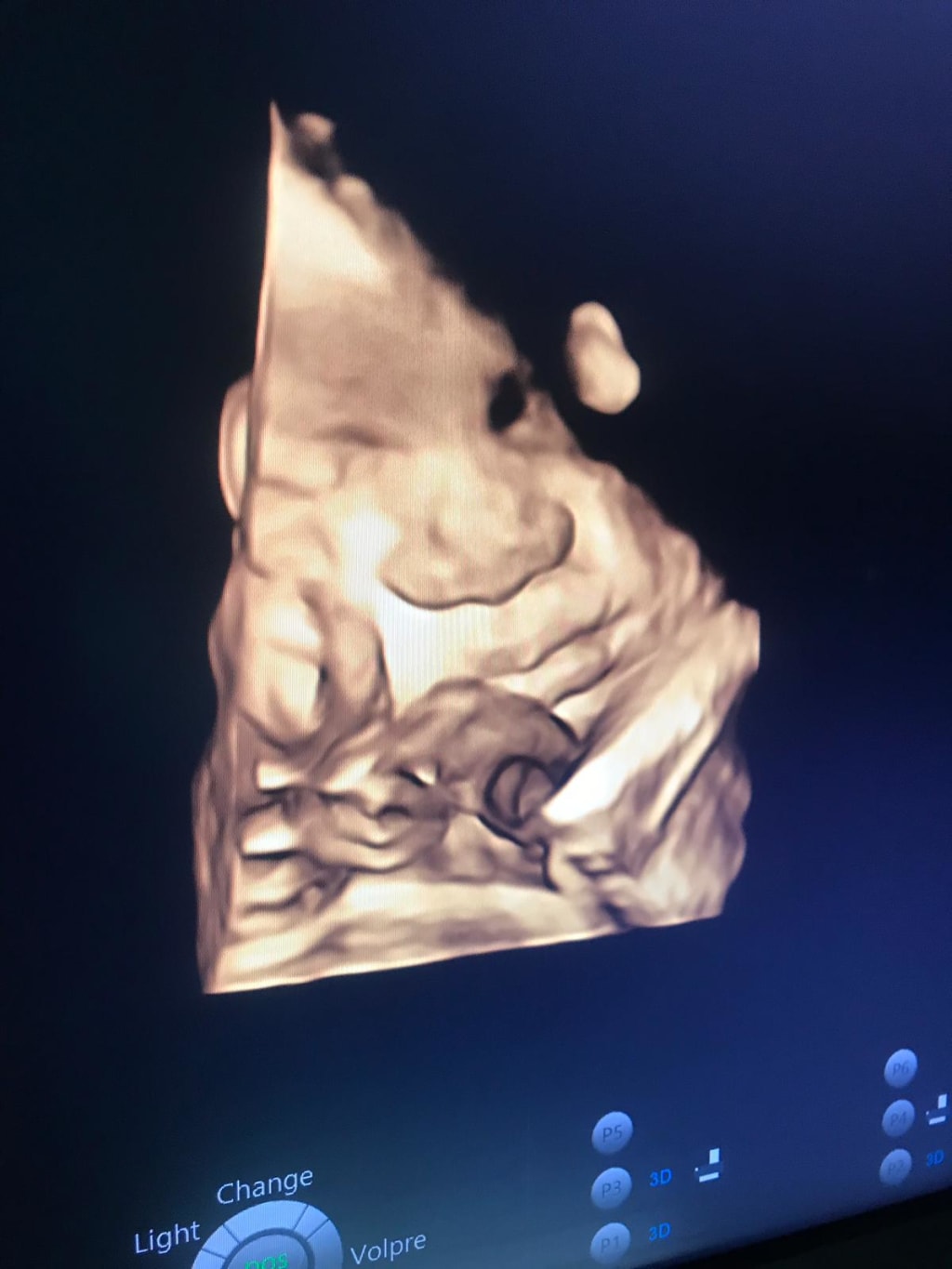 I Almost Died During Childbirth I Almost Died During Childbirth
