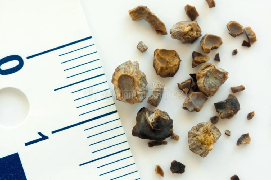 The Lowdown On Kidney Stones