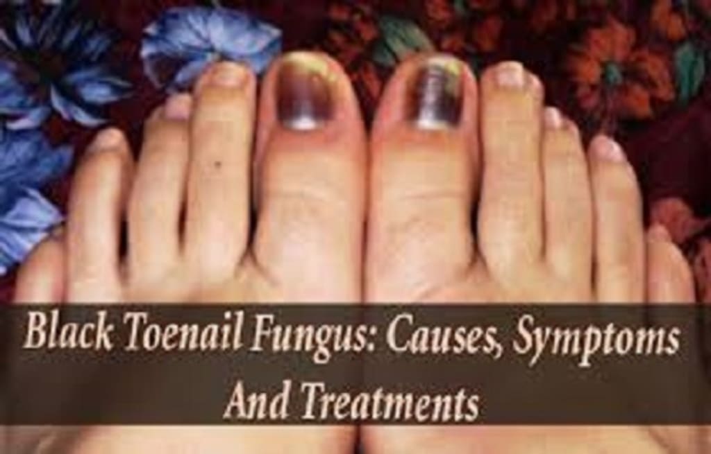 Causes Of Black Toenail Fungus Causes Of Black Toenail Fungus