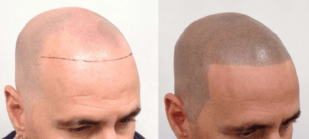 Scalp Micropigmentation- Implant Pigment Into The Scalp For Hairs Scalp Micropigmentation- Implant Pigment Into The Scalp For Hairs