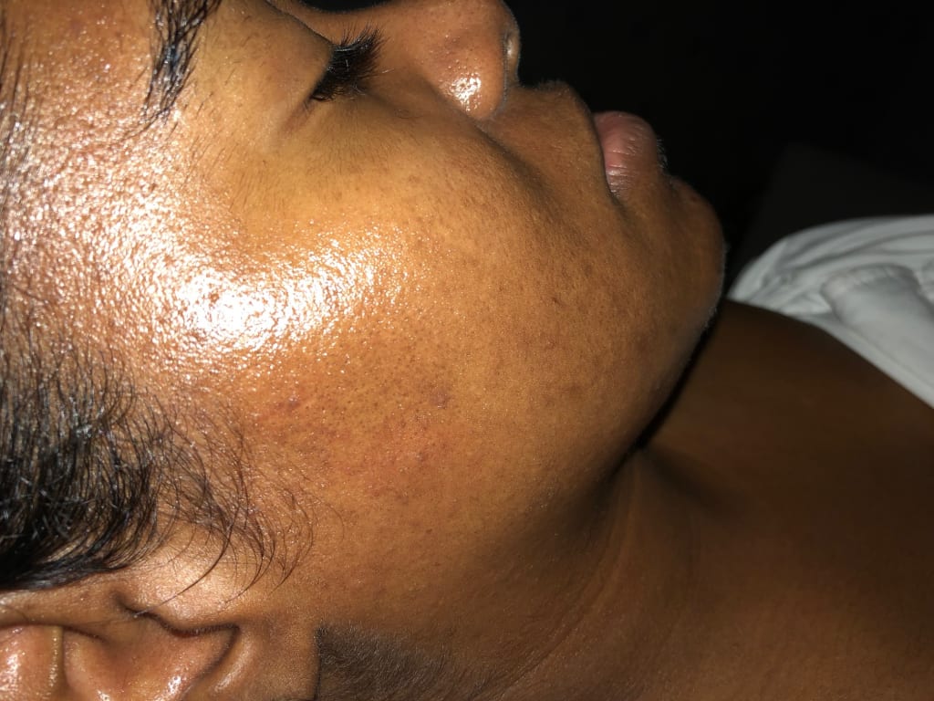I Have Post-Inflammatory Hyperpigmentation and Here is How I Live With It I Have Post-Inflammatory Hyperpigmentation and Here is How I Live With It