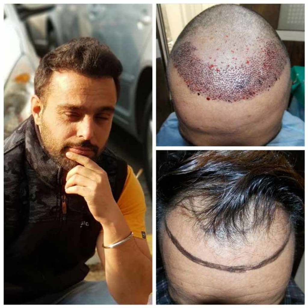 Is Hair Transplant a Painful Treatment? Is Hair Transplant a Painful Treatment?