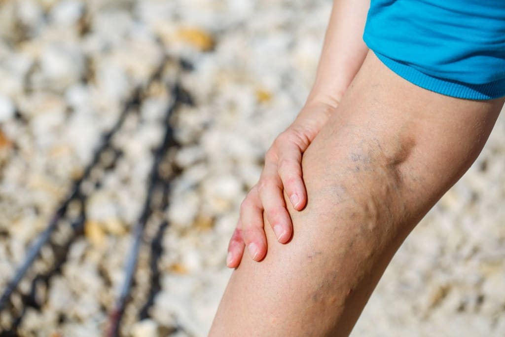 7 Most Common Misconceptions About Varicose Veins
7 Most Common Misconceptions About Varicose Veins
