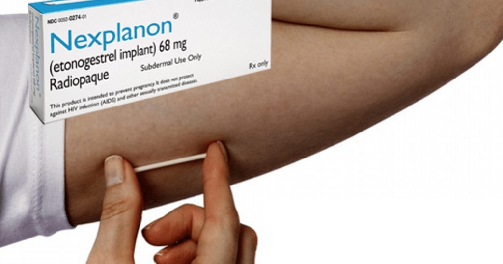 Nexplanon Horror Nexplanon Horror
