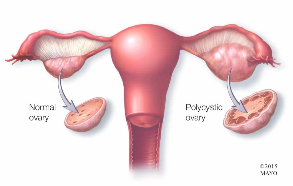 Finding Out I Have PCOS Finding Out I Have PCOS