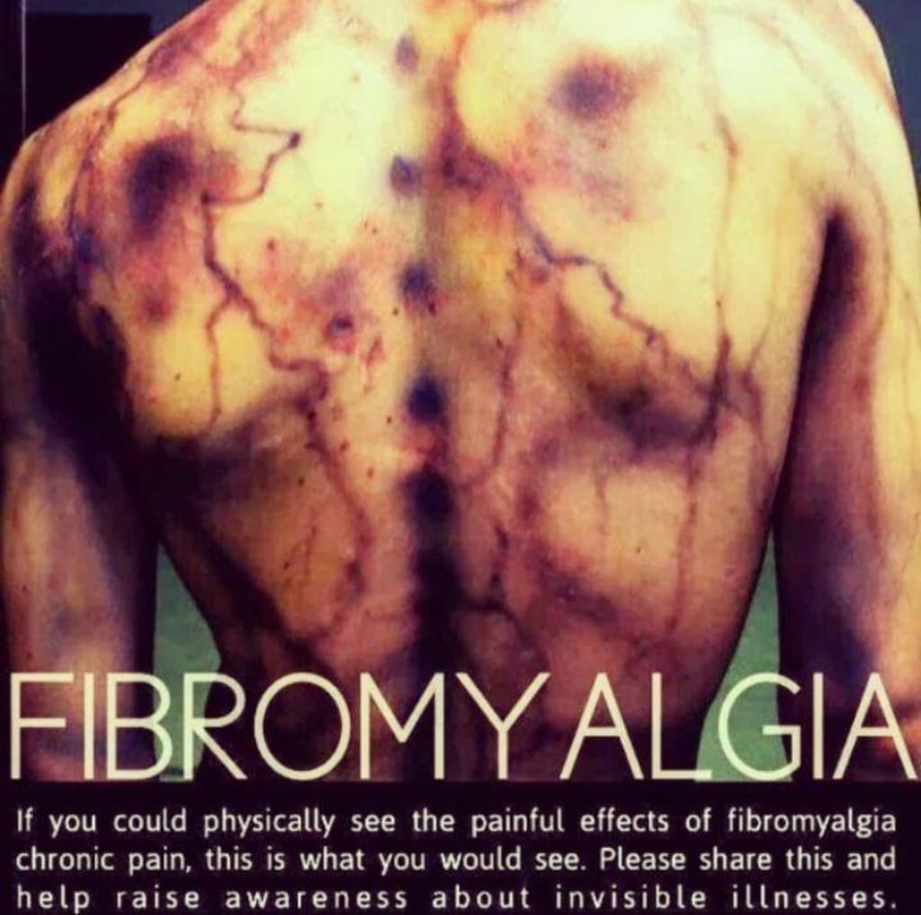 Fibromyalgia Fibromyalgia