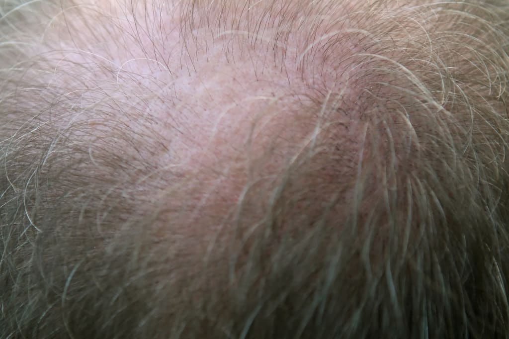 Losing Your Hair Hurts More than You Think Losing Your Hair Hurts More than You Think