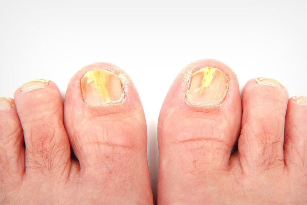 No More Fungus, at Least on Your Toenail No More Fungus, at Least on Your Toenail