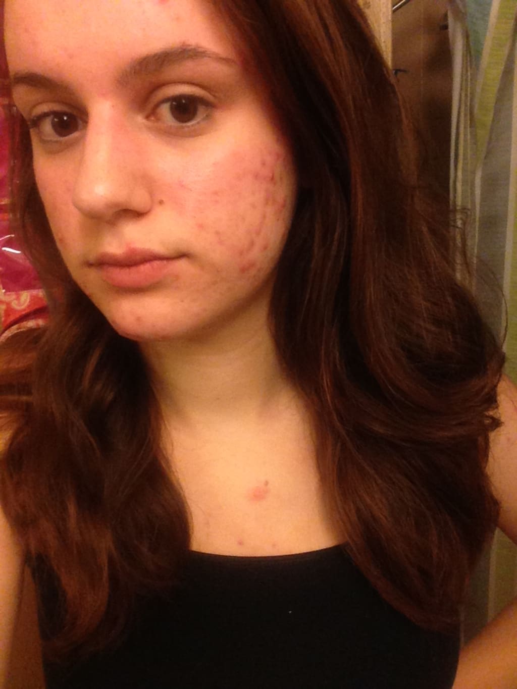 The Acne Aftermath: Self Esteem The Acne Aftermath: Self Esteem