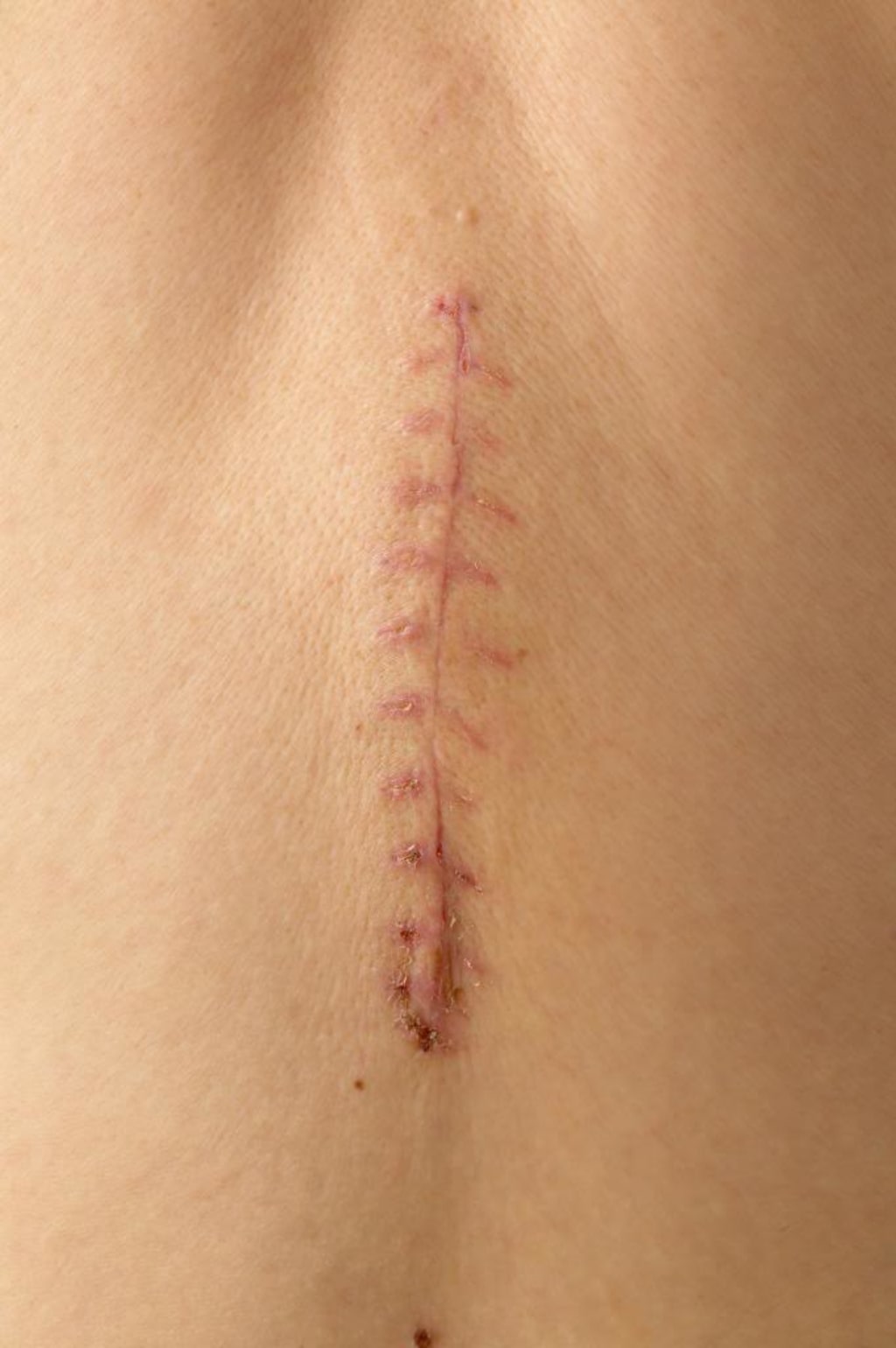 Overlapping Scars Overlapping Scars
