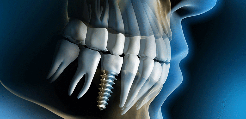 Microtechnology Research Could Help Dental Implant Healing Microtechnology Research Could Help Dental Implant Healing