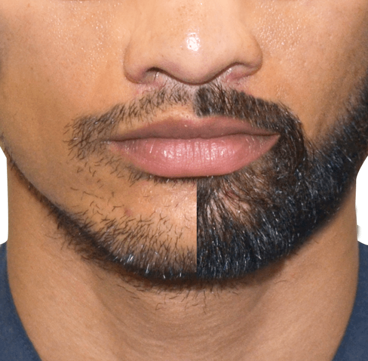 Beard TransplantThings to Know