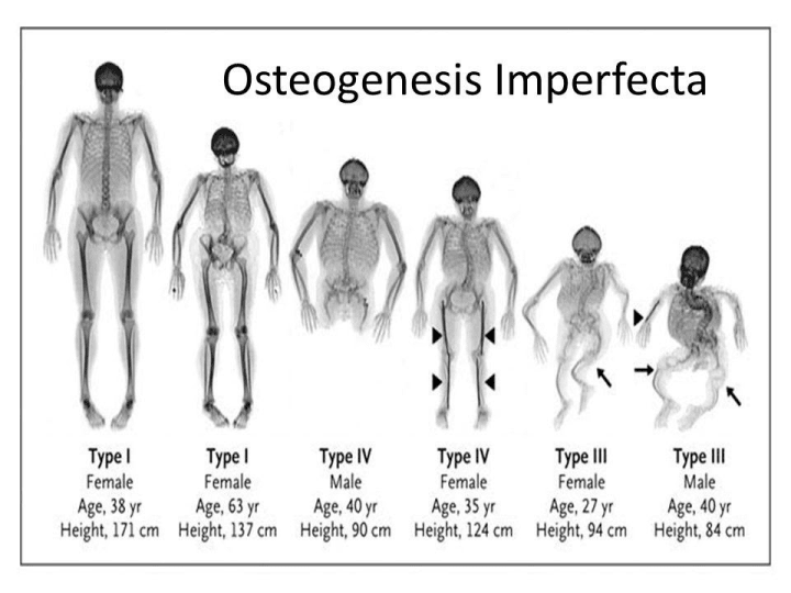 Osteogenesis Imperfecta