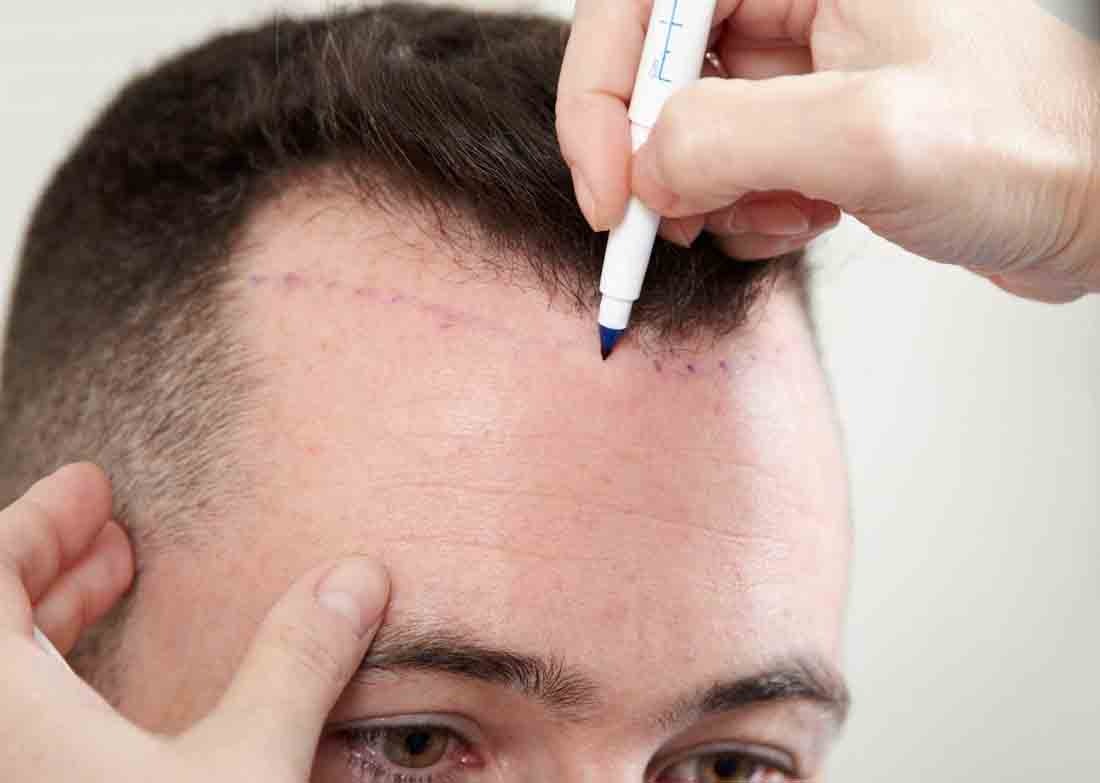How To Get A Perfect Hairline Design By Hair Transplantation? | Blush How To Get A Perfect Hairline Design By Hair Transplantation? | Blush