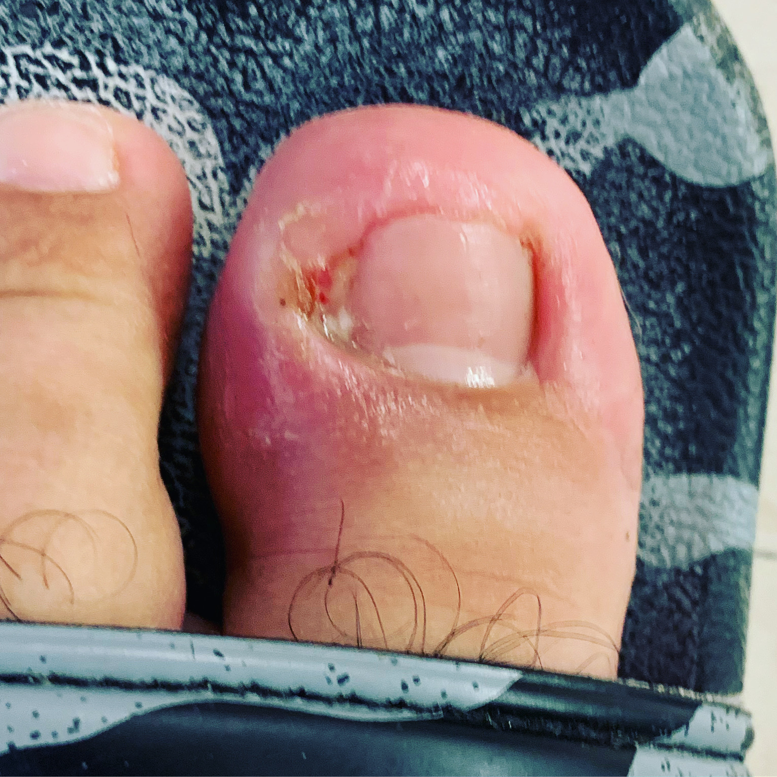 When To See A Physician After Painful Toenail Injury