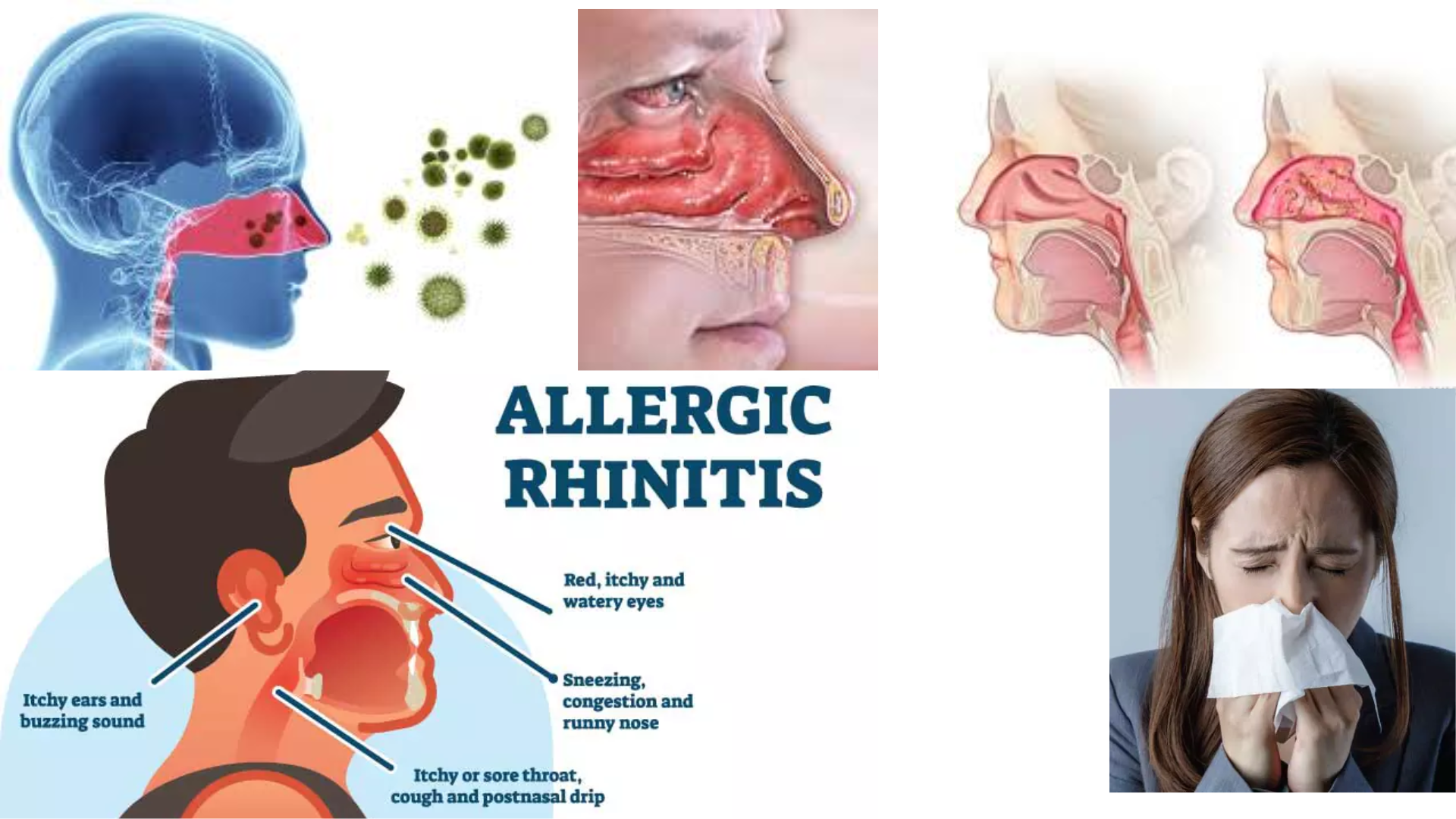 Allergic Rhinitis hay fever or seasonal allergy Humans