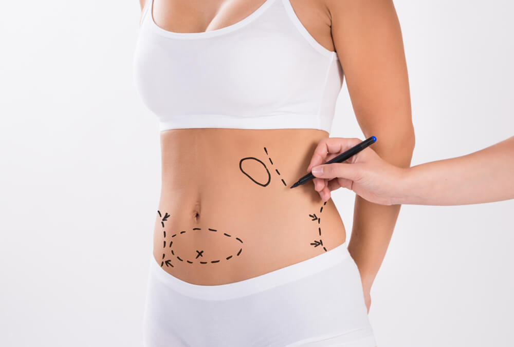 Liposuction Surgery | Vocal