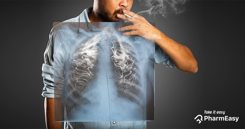 can cigarettes cause acid reflux 🚭💥 Did you know smoking—and even vaping—can cause heartburn and worsen acid  reflux? The latest research shows both habits increase your risk of GERD,  but the good news is quitting can make