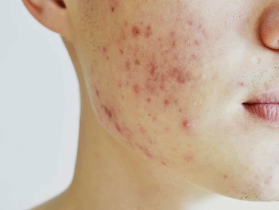 Ayurvedic Acne & Skin Wellness Therapy