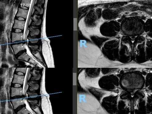 Hernia discal lumbar