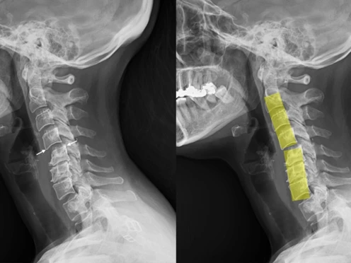 Inestabilidad cervical