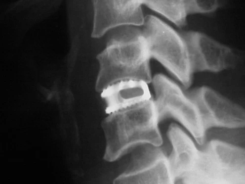 Artrosis Facetaria