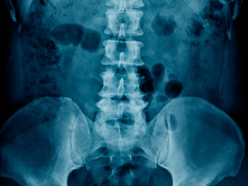 Lumbalgia