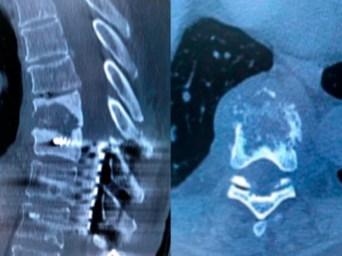 Infección vertebral