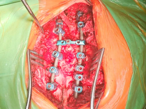 Artrodesis lumbar posterior