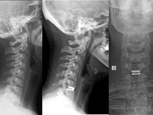 Prótesis cervical anatómica