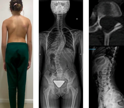 Escoliosis Idiopática
