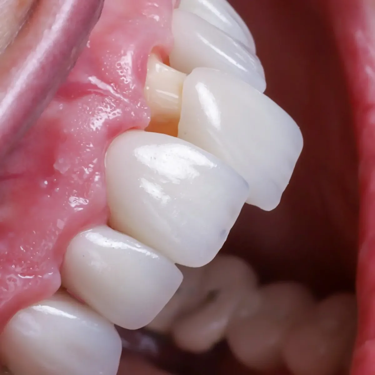 What Questions Should I Ask Before Getting Veneers?
