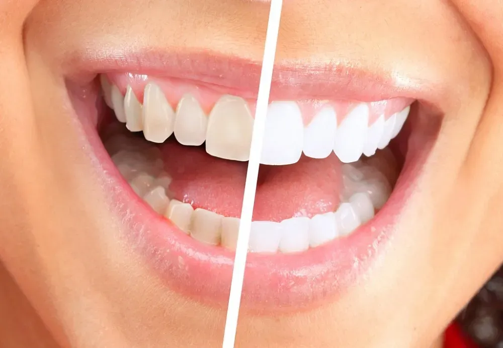 The Truth About Teeth Whitening: What You Need To Know Before Your Next Appointment