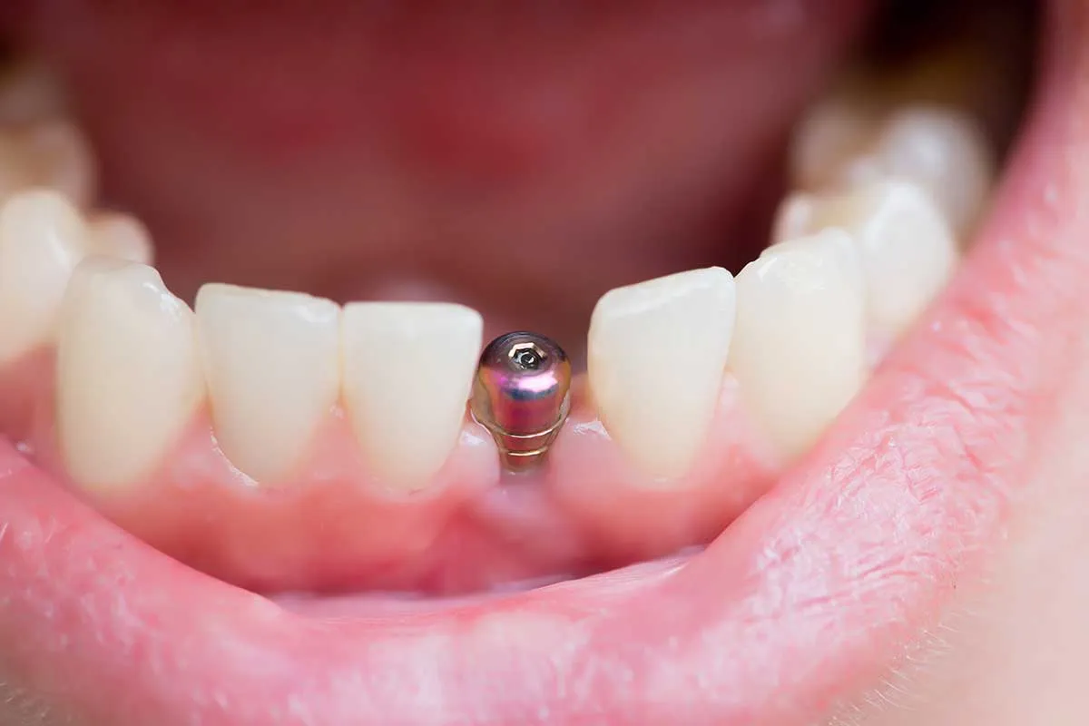 Why Are Dental Implants Cheaper in Costa Rica?