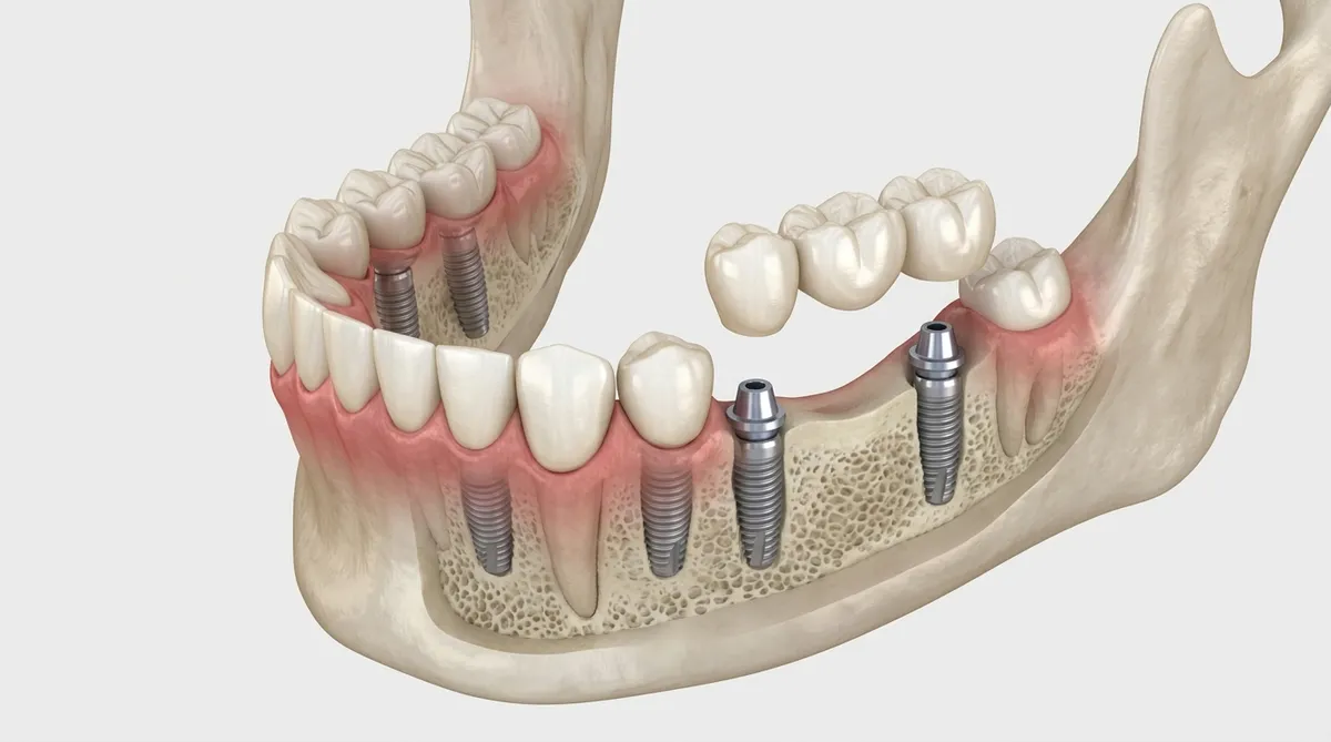 How Many Dental Implants Do You Need?