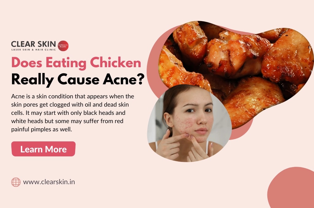 Can Chicken Cause Pimples? Uncover the Surprising Truth!